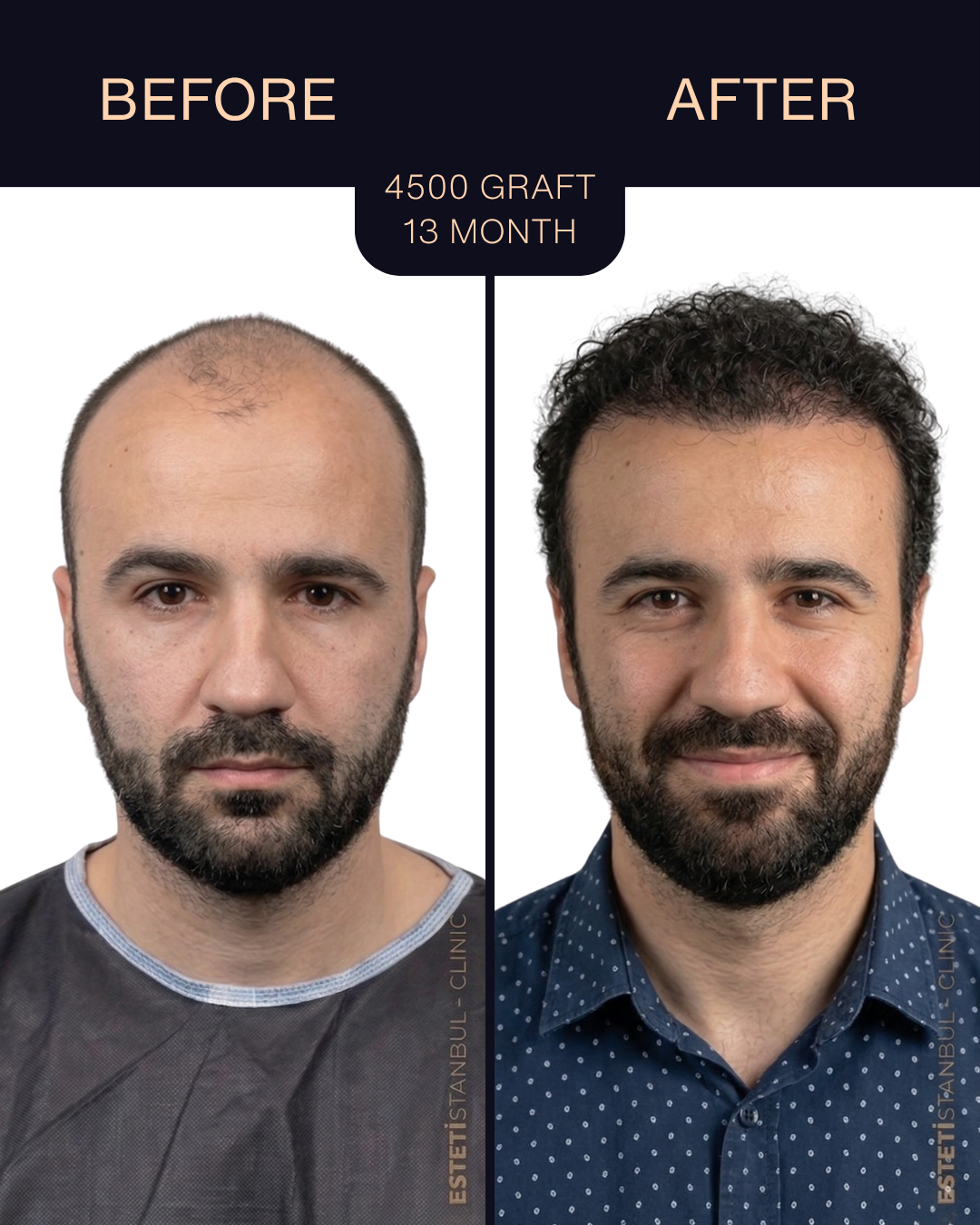 Hair transplant result - 4500 grafts