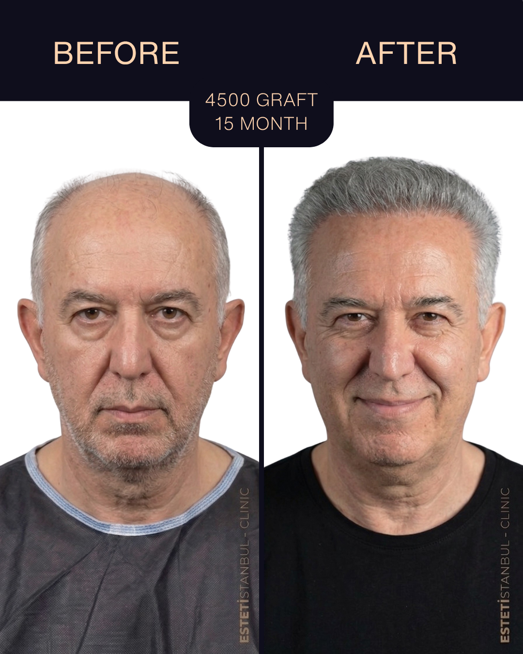 Hair transplant result - 4500 grafts