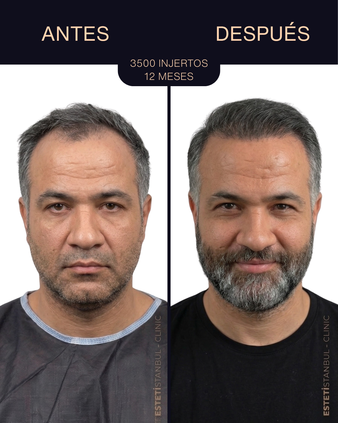 Resultado de trasplante capilar - 3500 injertos