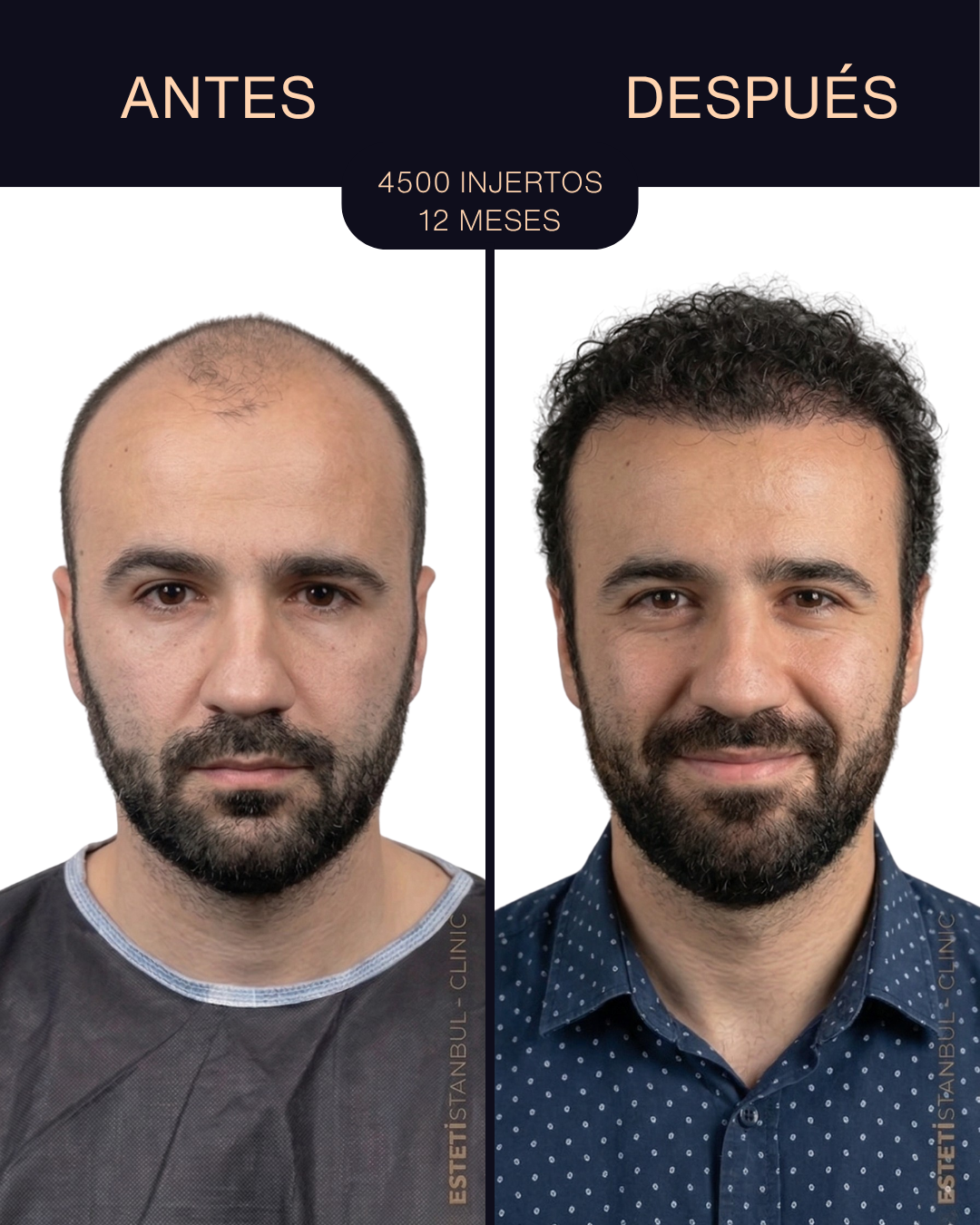 Resultado de trasplante capilar - 4500 injertos