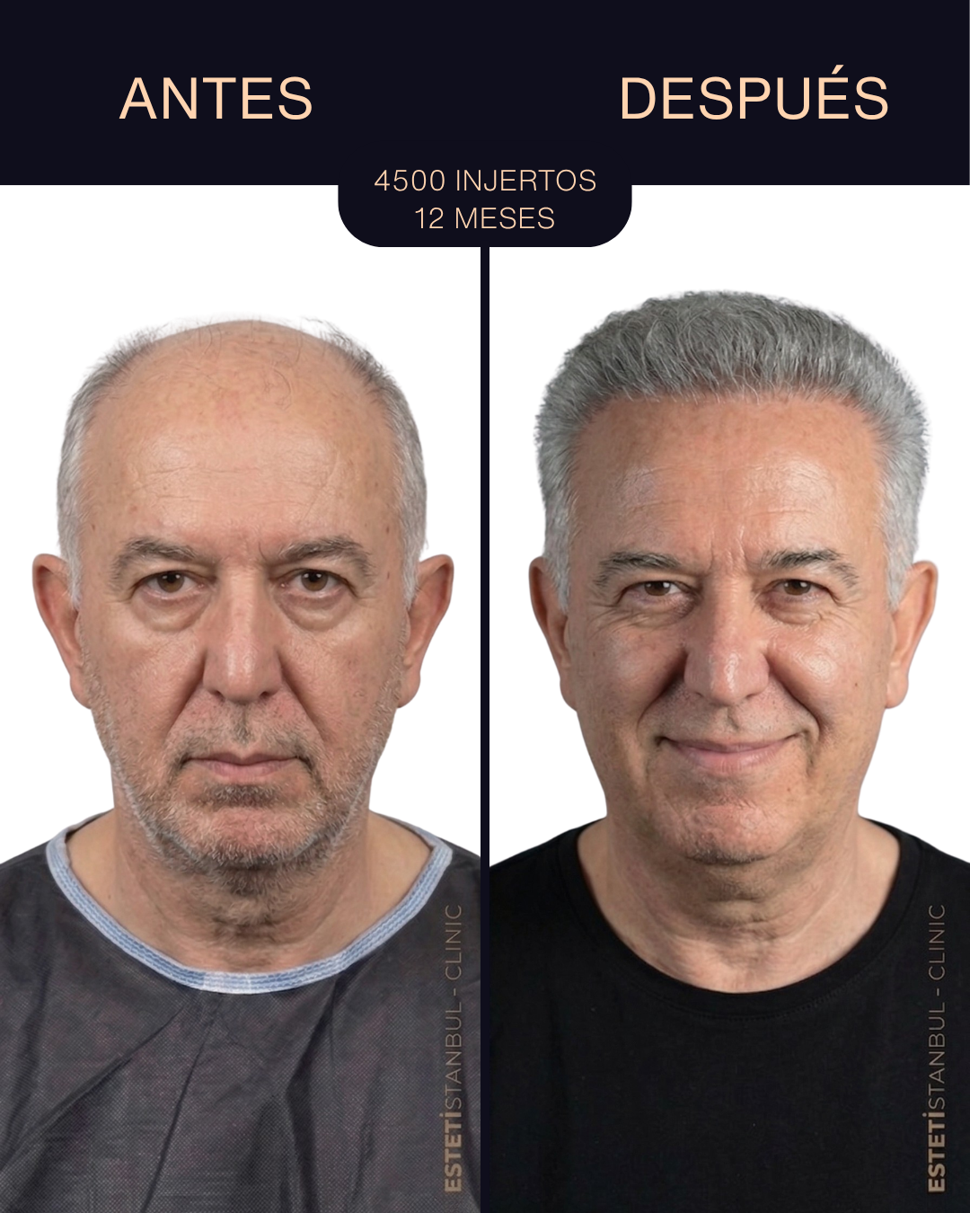 Resultado de trasplante capilar - 4500 injertos