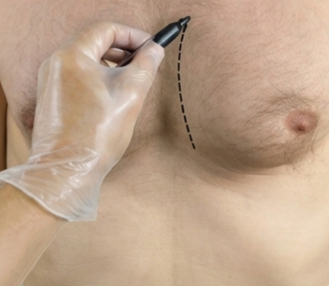 Erkekte Göğüs Küçültme